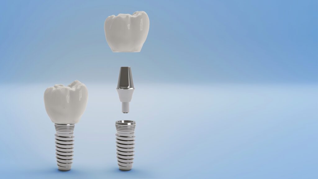 Dental Implants in Keego Harbor, MI
