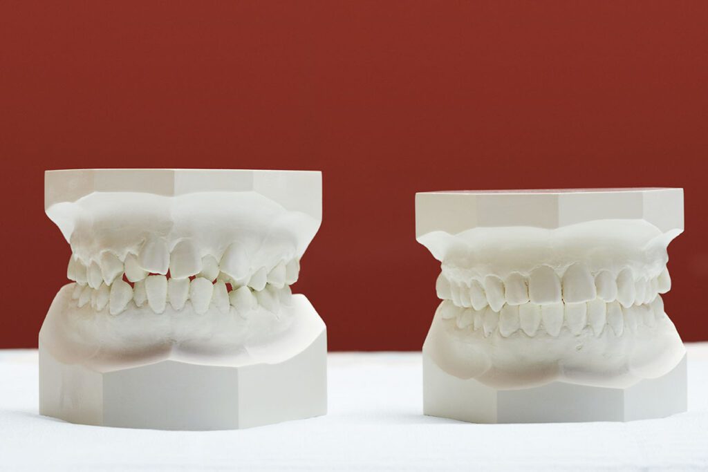 In this article, we will explore how Invisalign works and why it might be the right option for your smile and bite.