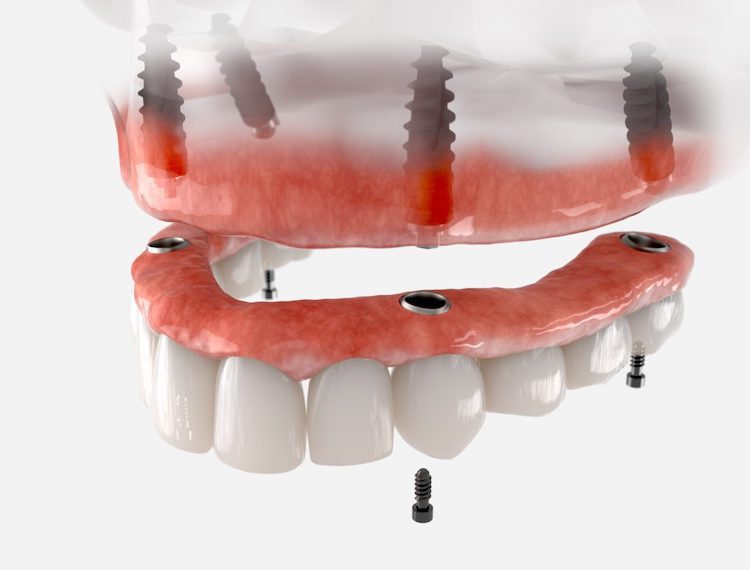 Two solutions exist for replacing missing teeth: dental implants and dentures. Each option offers distinct advantages and disadvantages.